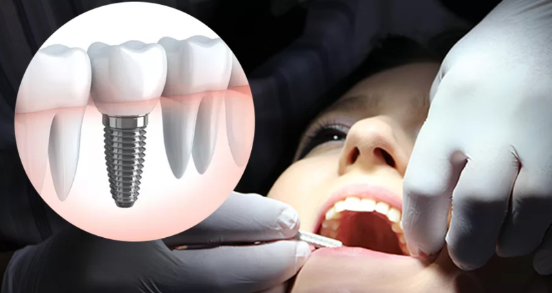 IMPLANTE + CORONA DE ZIRCONIO 990€